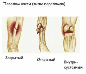 types de fractures de la main