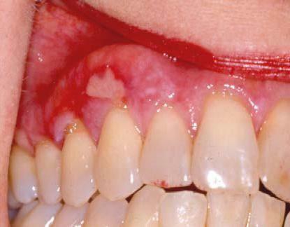 Lichen merah rata di rongga mulut