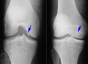 osteofyty kolenného kĺbu