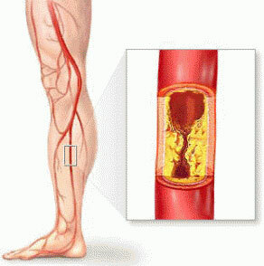 Vylučuje aterosklerózu ciev dolných končatín