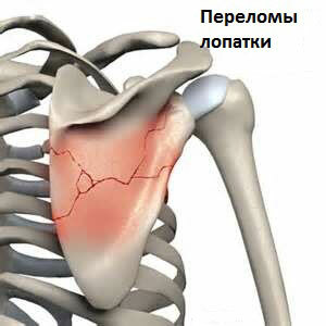 fracture of scapula