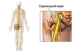Pincering of the sciatic nerve