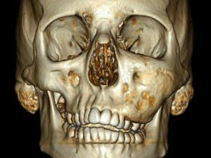 fibrotic dysplasia of the skull