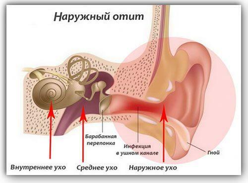 Externé zápal stredného ucha