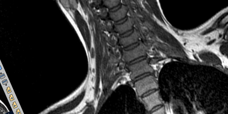 What MRI of the cervical spine shows