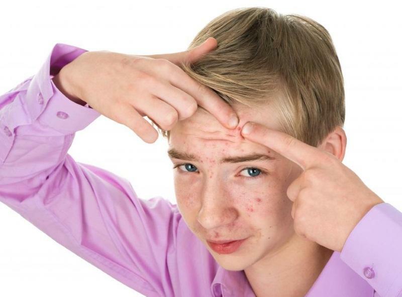 Acne em adolescentes - um fenômeno normal associado a alterações hormonais no corpo
