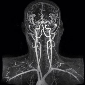 cerebralna vaskulatura