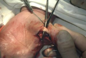 tendon chirurgie