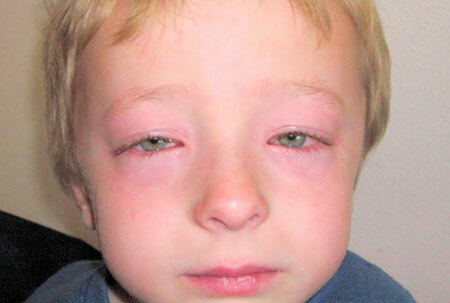 Sintomas do edema de Quincke em crianças