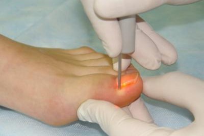 Corecția cu laser a unghiilor de la picioare, a unghiilor de la picioare, a unghiilor încarnate. Ce este, cum o fac, prețul