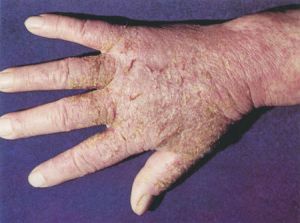 Eczema en la mano