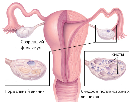 Polycysteuze eierstok