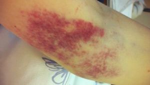 Hemorrhage in the elbow