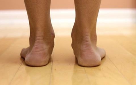 Limitation of mobility with flat feet