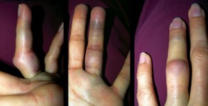 symptoms with a finger dislocation