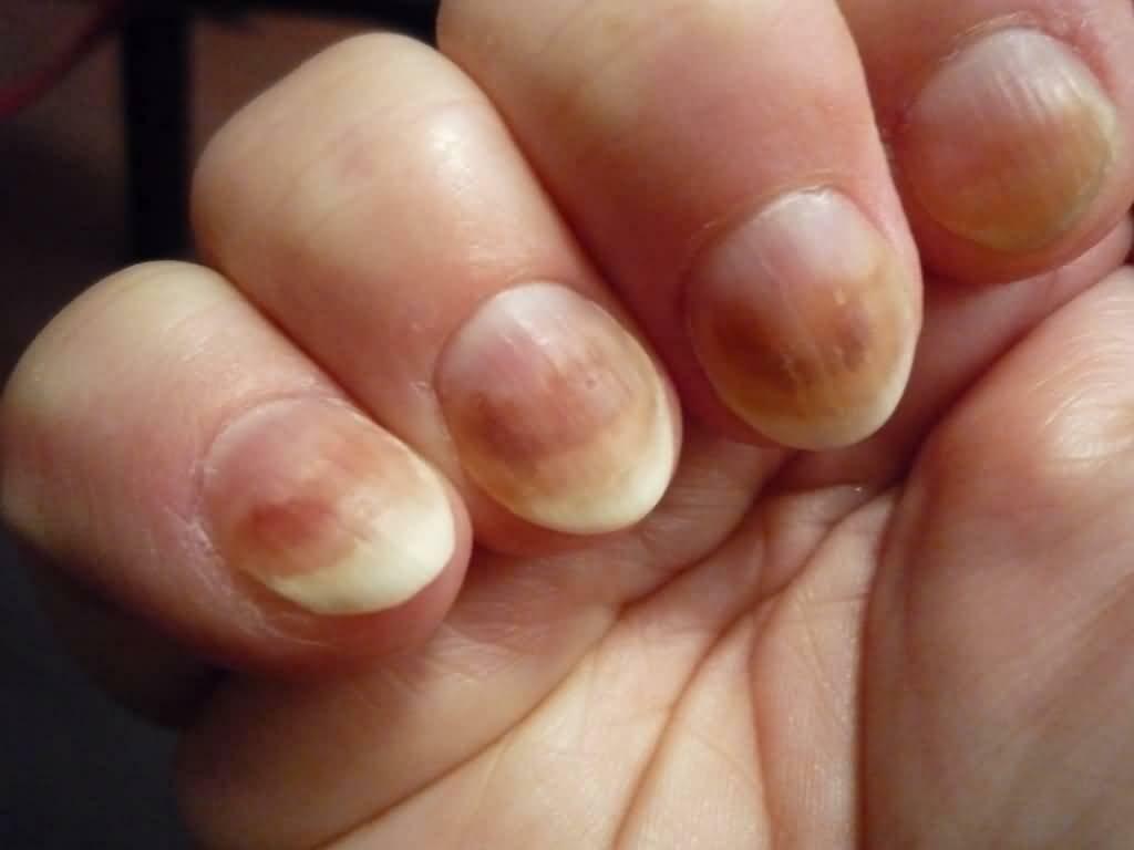 Fungus of the nail on the hands