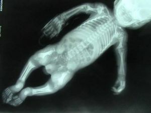 X-ray of joints of the child