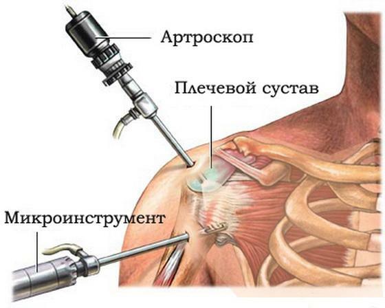 Artroscopia da articulação do ombro