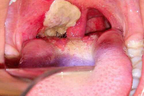 Diphtheria, throat photo