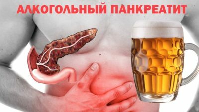 Akut alkoholpankreatit: symtom och behandling