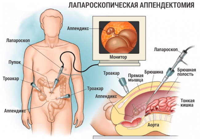 Apendektoomia Volkovich-Dyakonovi järgi pararektaalse sisselõike abil Lenanderi järgi