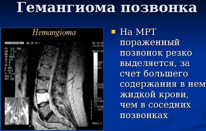 המנגיומה של החוליה על MRI, CT, רנטגן, מה זה, השלכות, טיפול