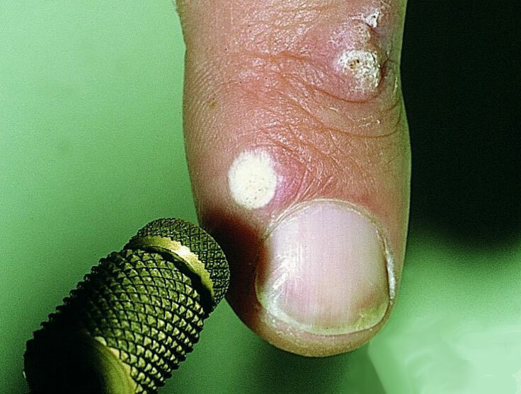 Warts on the legs - how to get rid, treatment, means, reasons, prices for removal, photo