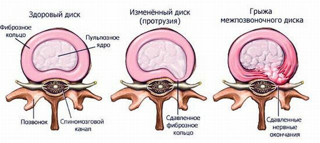 Symptome und Behandlung von Vorsprüngen der Bandscheiben der Lendenwirbelsäule