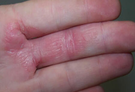 Symptoms of wet eczema