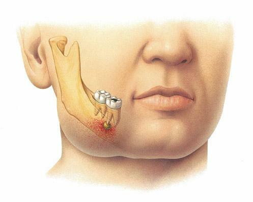 Periostitis ist eine Komplikation, die Infektionskrankheiten der Mundhöhle begleitet