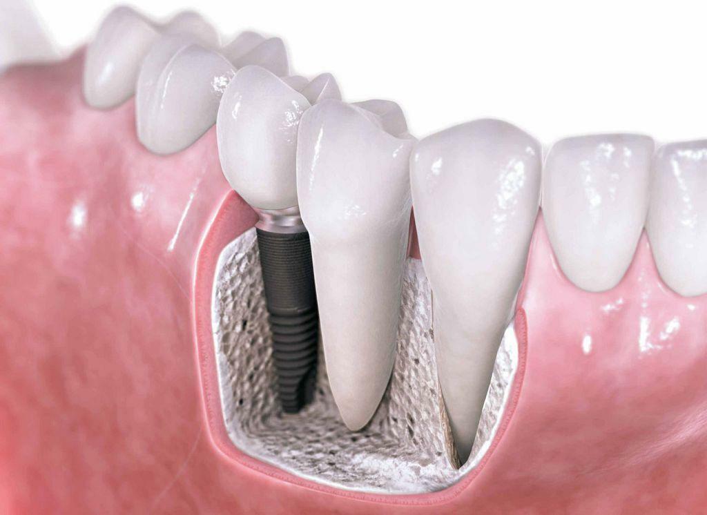 Dantų implantų vaizdavimas