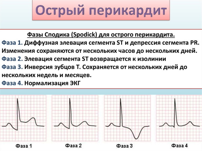 Elevation of the ST segment on the ECG. What is it: v1-2-3, as evidenced by