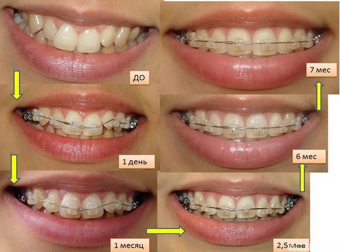 A garota tem dentes tortos. Fotos antes e depois, como consertar, métodos com e sem aparelho