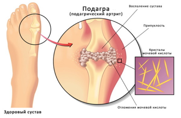 Brennen in den Beinen unterhalb des Knies. Ursachen und Behandlung