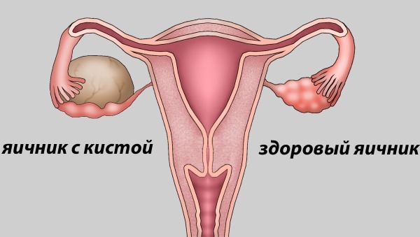 endometriose. Symptomen en de behandeling van folk remedies, voorspelling