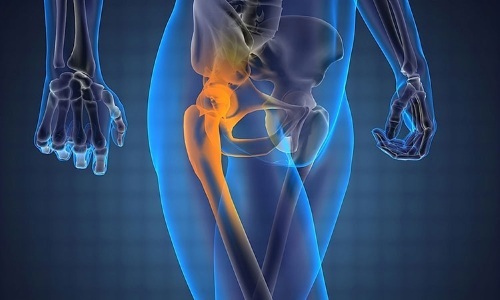 Hip joint impingement syndrome. Symptoms, signs, treatment