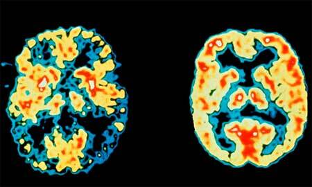 progression af Alzheimers sygdom