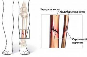fatigue fracture of the tibia