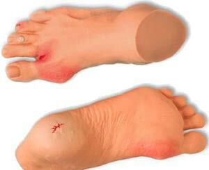 Prevention of diabetic foot in diabetes mellitus