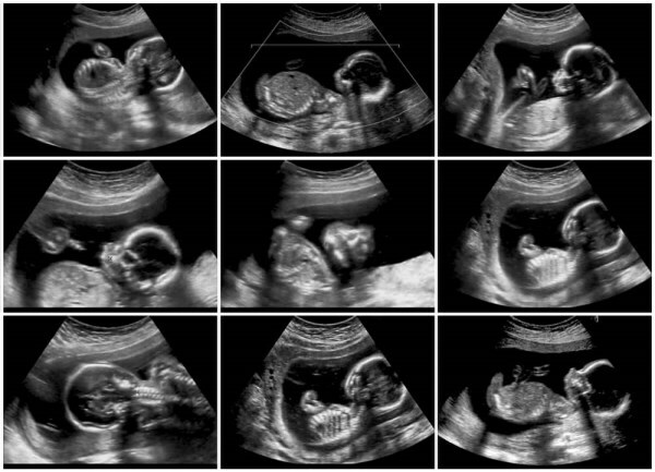 Klicks im Bauch während der frühen, späten Schwangerschaft