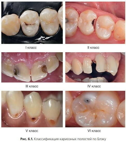 Black caries classification in pictures. table