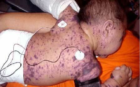Purpura trombocytopenie - typen, symptomen( foto's) bij kinderen en volwassenen