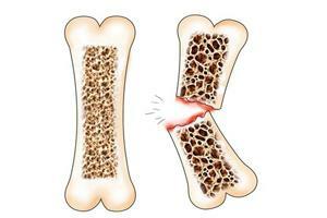 Fracture avec ostéoporose