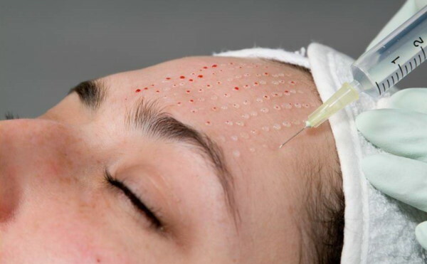 Métodos de tratamento da acne. Prós e contras, preço, comentários