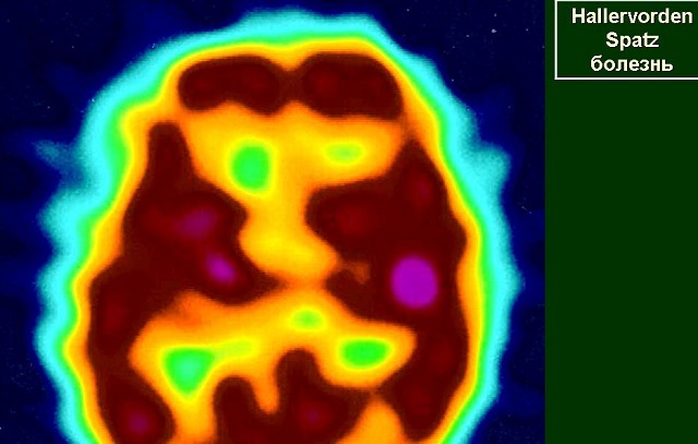 Gallerwarden-Spartz neurodegeneratie: symptomen, behandeling, prognose