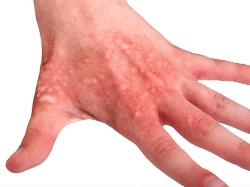Watery bumps on hands, palms, fingers. What is it, how to treat