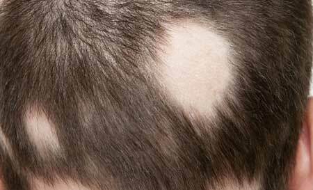 Focal alopecia kuvia