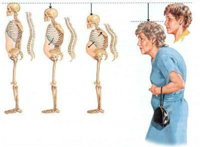 Entonces, gradualmente, la postura cambia con la osteoporosis
