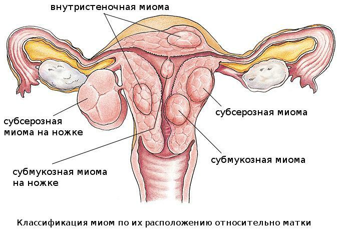 Clasificarea miomelor uterine