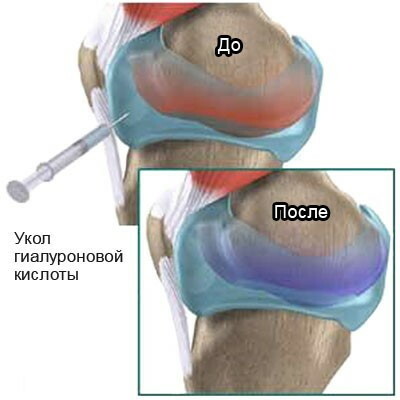 Artroplastika kolena. Cena, rehabilitácia